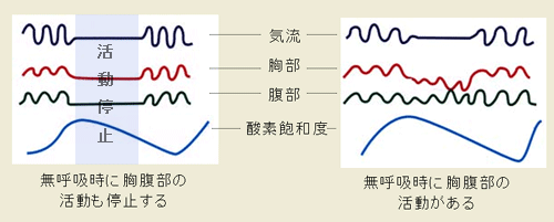 睡眠時無呼吸症候群と生活習慣病 いい眠りしてますか Sasとは